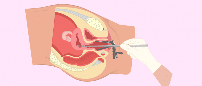 legrado uterino
